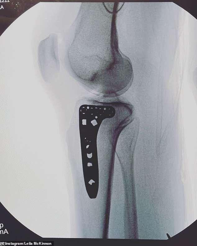 In her caption at the time, Leila explained that she had to have a pin inserted into her shattered knee as she shared photos of her X-rays.