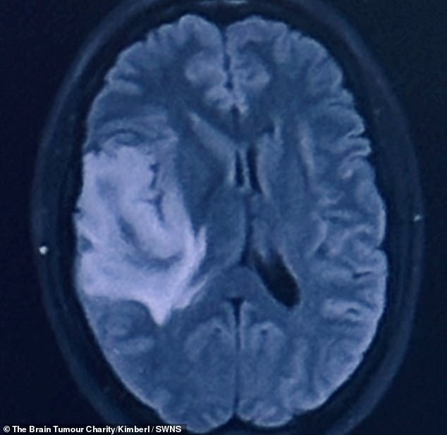 Since then, she has also struggled with sepsis, which delayed the start of treatment. In the photo Mrs Baggley's brain scan showing the tumor (light blue)