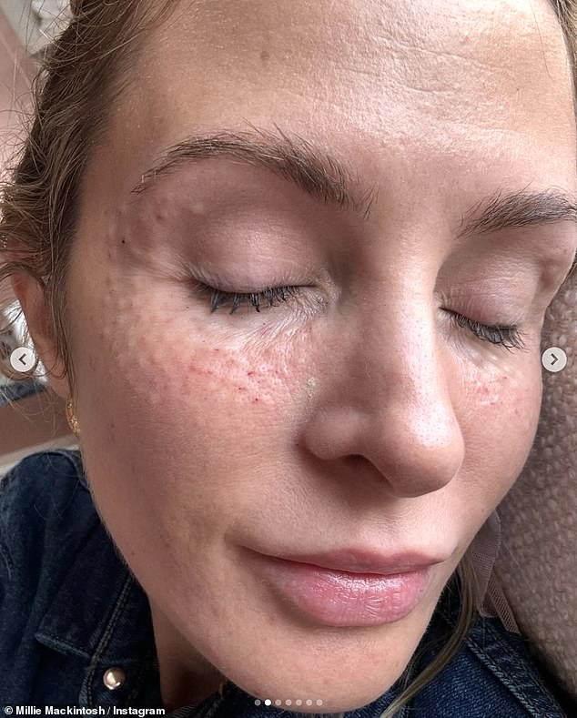 The former Made In Chelsea star, 35, took to her Instagram on Thursday to list her favorite beauty treatments for her followers and explained how important it was for her to be transparent about what she has done