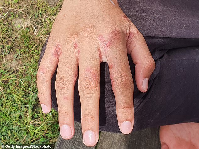 Health officials are warning the public to be vigilant for the symptoms of scabies, which can appear as a red rash between the fingers