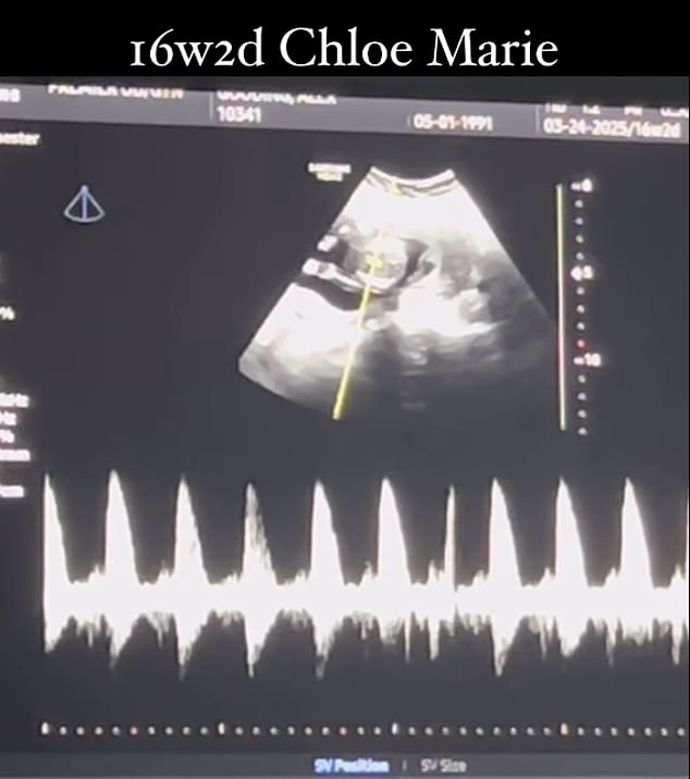 The above shows the fetus, which she has named Chloe, in the womb