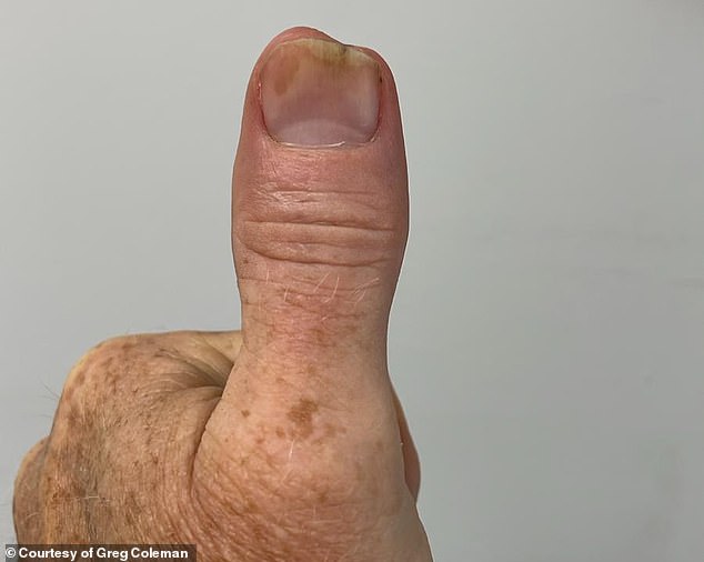 The bacterial infection penetrated Mr. Coleman's thumb bone, so he had to have the tip removed