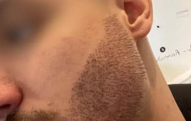 The treatment left the Frenchman's beard with an irregular shape and growing at an unnatural angle