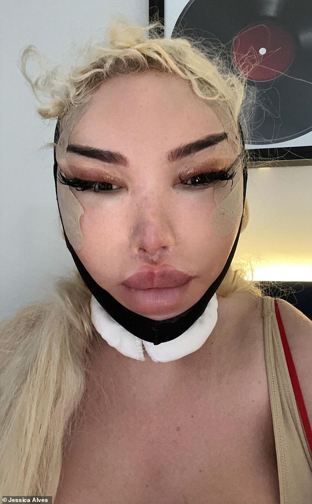 Jessica, who has spent over £1 million on more than 100 procedures, has traveled to Turkey to have her filler dissolved in the hope of achieving a more natural look