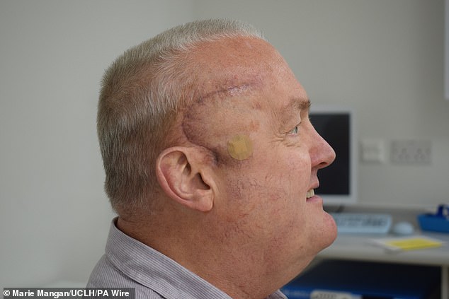 The 62-year-old engineer from Luton is the first patient to take part in the trial and has seen his tumor shrink by half in just a few weeks. For the procedure, surgeons removed as much tumor as possible before implanting a small medical device called an Ommaya reservoir under the scalp, which connects to the tumor via a small tube.