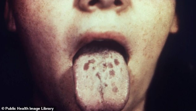 Cases of the sexually transmitted disease syphilis, which was widespread in the 18th and 19th centuries, are at their highest level since the 1940s