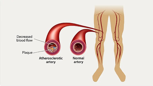 Cholesterol can build up in the small blood vessels in the legs, causing pain when walking, numbness, hair loss, shiny skin and ulcers, all signs of PAD. Catching and diagnosing PAD can help a person avoid heart disease, stroke or amputation in the future, Dr. Pollak said.