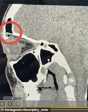 On Thursday, Rhea took to her Instagram page to confirm the injury by sharing two x-rays of her broken face