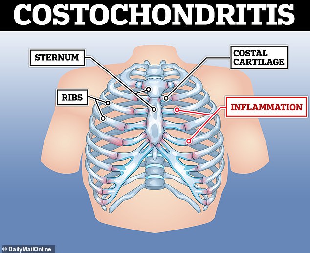 Inflamed cartilage connecting the breastbone to the ribs causes costochondritis. The inflammation causes pain that radiates from the front of the chest to the back and up to the neck