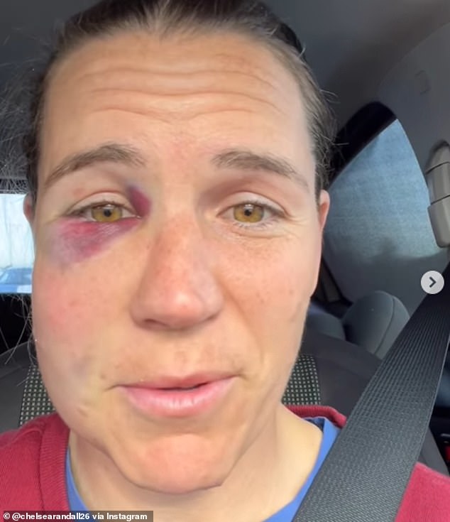 Adelaide Crows star Chelsea Randall has revealed the painful-looking injury she suffered after a head collision with Collingwood's Eliza James on Sunday