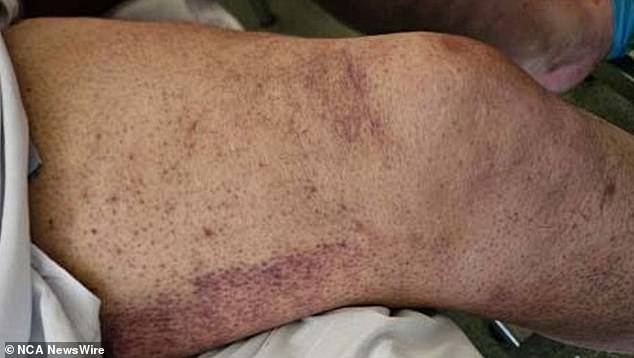 A middle-aged man was recently admitted to Sir Charles Gairdner Hospital in Perth with the rare disease scurvy. His symptoms include a painful rash (pictured)