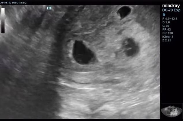 Lauren shared a video of an ultrasound showing that the couple are having triplets