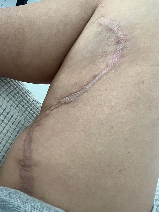 The operation to remove biopolymers from Ms Arias' legs left her with a huge scar. Photo provided by Ms. Arias