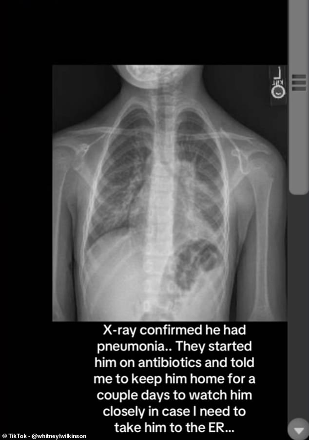 Mrs Wilkinson said her son was diagnosed via an X-ray after suffering from a cough for a week