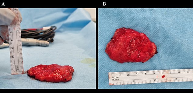 MRI scans taken at Copenhagen University Hospital showed that the lump was 33 cm in size and that the skin and tissue around it had thickened