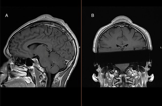 The condition is also called the 'headspin hole' or 'defect bulge' and also causes a lump on the scalp and tenderness. Pictured: MRI scan results of the man from Denmark, showing the tumor mass