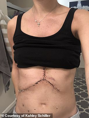 Pictured here is Ms. Schiller's scar from her liver transplant