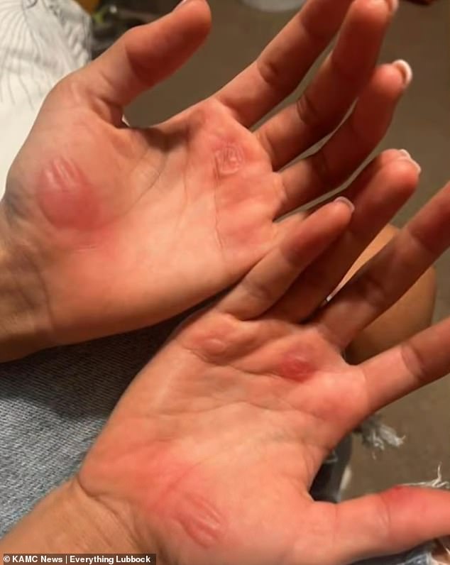 Eighth-grade cheerleaders at Evans Middle School in Lubbock, Texas, suffer first- and second-degree burns after a 'punishment' imposed by their own coach