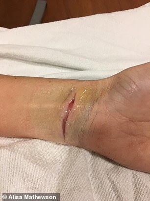 Alisa shared photos of the gruesome wrist wounds inflicted by her husband