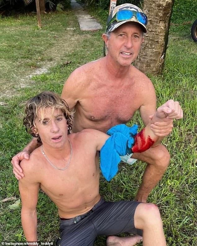 Teddy Wittemann, 16, was surfing at Melbourne Beach, near Orlando, when he was mauled by a shark. Dave Crespi tied his shirt above the wound like a tourniquet