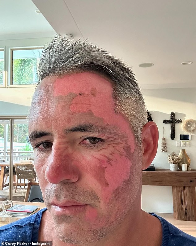 Corey Parker suffered first-degree burns to his face and arm in an accident at a friend's farm