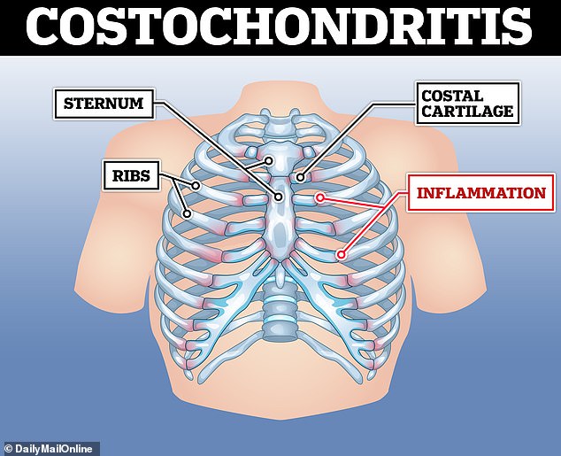 Inflamed cartilage connecting the breastbone to the ribs causes costochondritis. The inflammation causes pain that radiates from the front of the chest to the back and up to the neck