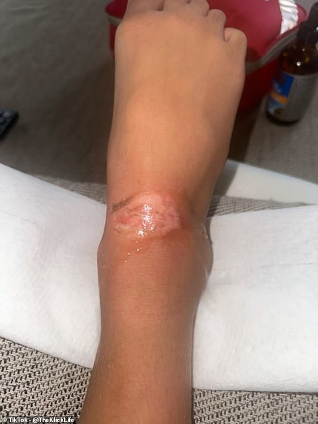 As a warning to others, Ms Klick posted a video detailing the event to her TikTok and Instagram accounts. Above is a photo of Sienna's burns