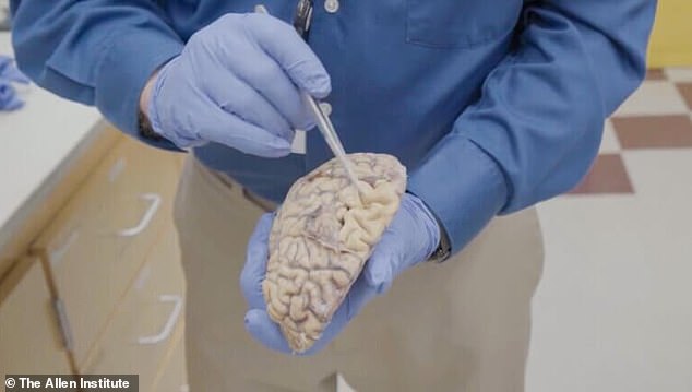 A doctor from the Allen Institute has shown that the folds in the brain of a person with advanced dementia are further apart than in a healthy brain, which is evidence of tissue loss.