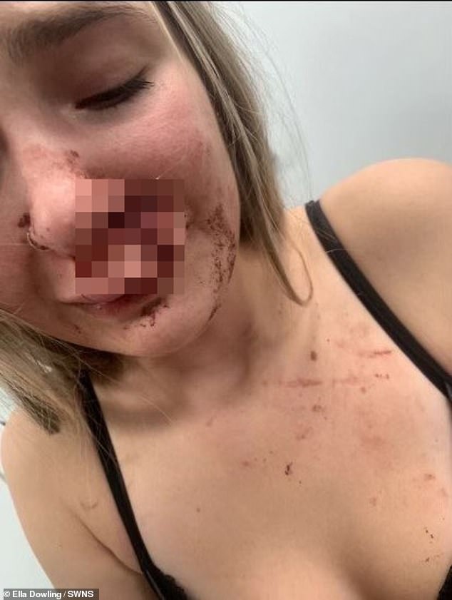 Ella Dowling, 19, required 50 stitches and reconstructive surgery after a horrific attack in which her face was 'bitten off' by a stranger on a bus