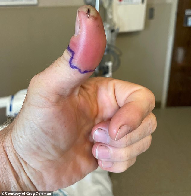 Greg Coleman, 53, was at Topsail Beach in North Carolina when he suffered a small cut on his thumb that continued to worsen