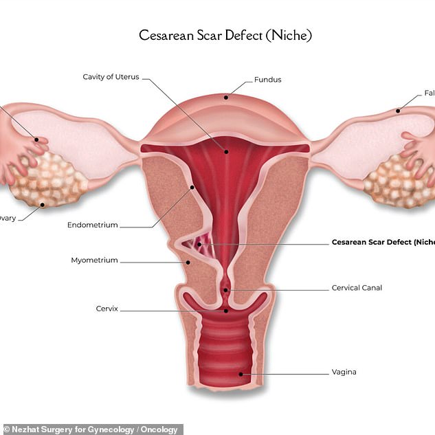 The above, from the Nezhat surgery in New York City, shows the appearance of the uterus when it has a scar from a cesarean section. With a CSEP, the embryo implants in the scar