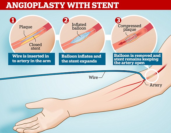 A stent is a wire mesh tube used to keep an artery open during an angioplasty. Once the balloon is removed, the stent is left behind to keep the artery open