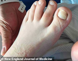 The above image shows the horizontal ridges on the 12-year-old American boy's toenails as they had become brittle due to multiple deficiencies of essential nutrients