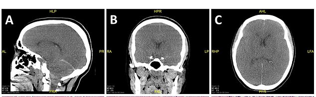 In June, a chronic marijuana user died after the condition caused a fatal heart arrhythmia. CT scans of the woman's brain showed the extent of the damage caused by a lack of oxygen when her severe vomiting caused a fatal irregular heartbeat. The brain folds are flattened and the entire brain is swollen