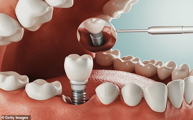 Implant surgery involves removing a single tooth and replacing it with a metal post anchored into the jaw. The post is then covered with a prosthetic tooth, often a porcelain crown