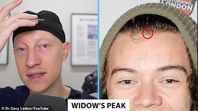 Dr. Linkov said in 2012 that Harry appeared to be having widow's peak