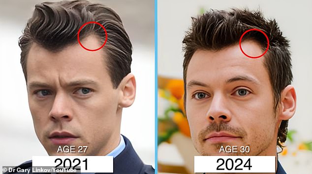 Dr. Gary Linkov, based in New York City, pointed to these photos from 2021 and 2024 as possible signs that Harry Styles had a minor hair transplant