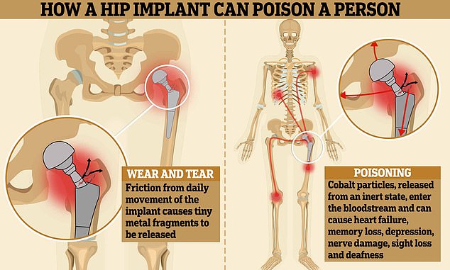 The problems stem from a type of flexible hip implant used in Britain between 2009 and 2017, mainly among younger patients who were thought to benefit most from it.