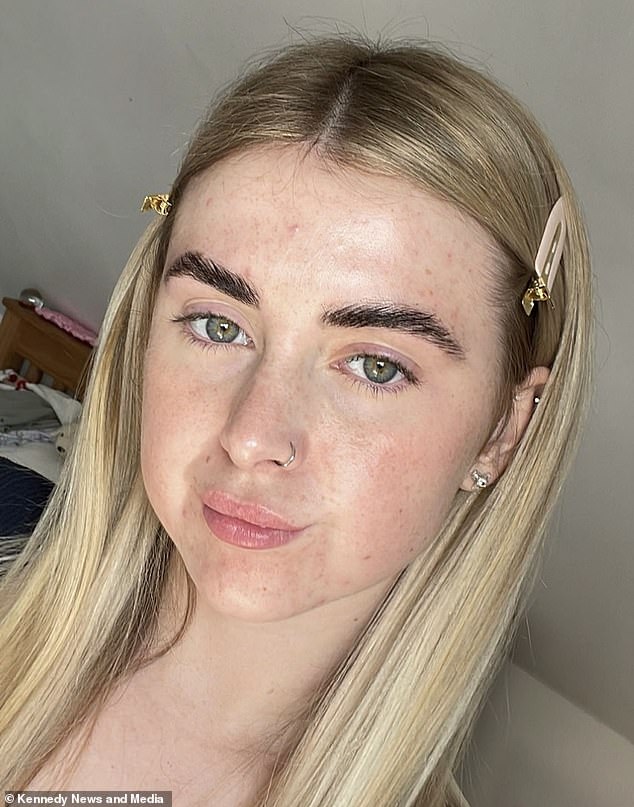 Melia Nielsen, from Grimsby, Lincolnshire, had been visiting a clinic for months to undergo chemical peels as she battled her pimples before trying a £75 microneedling procedure to treat her acne scars