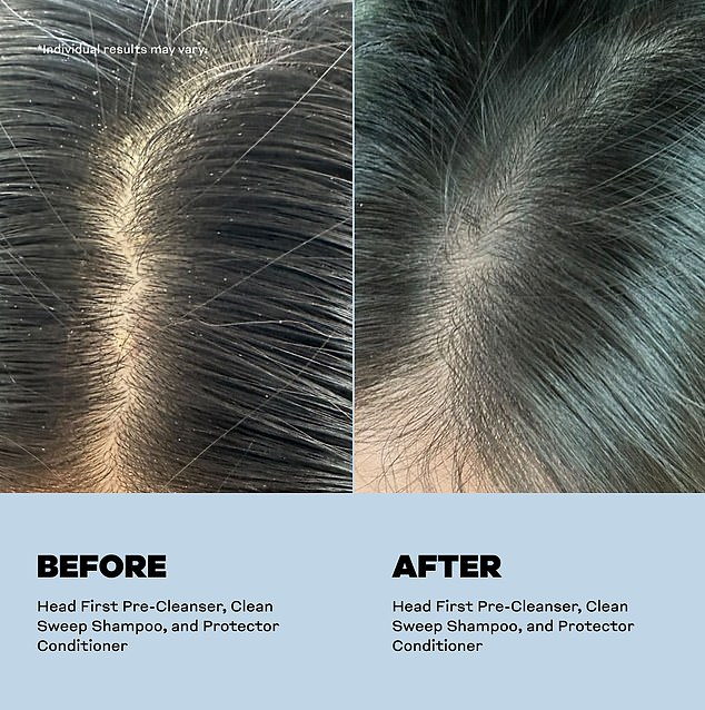 The woman was able to keep her dandruff at bay after using skelp!, an Aussie hair care brand