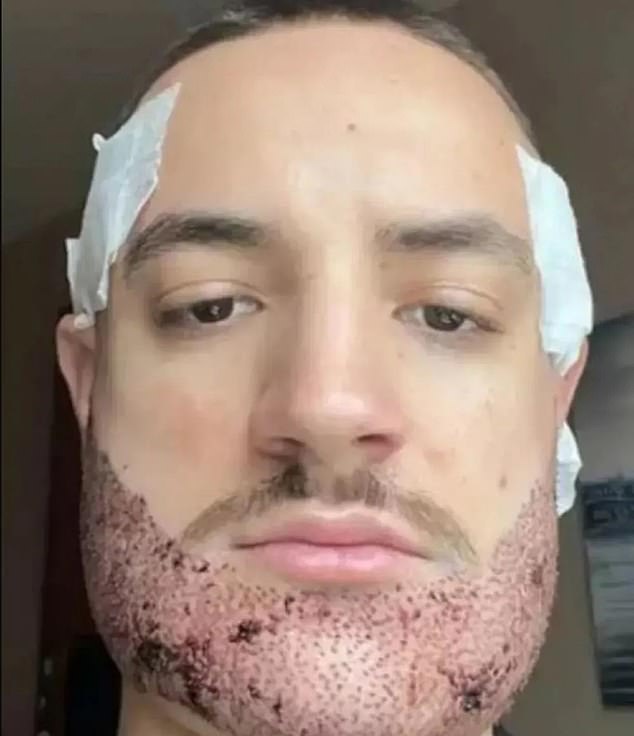 Mathieu Vigier Latour after his failed hair transplant in Istanbul