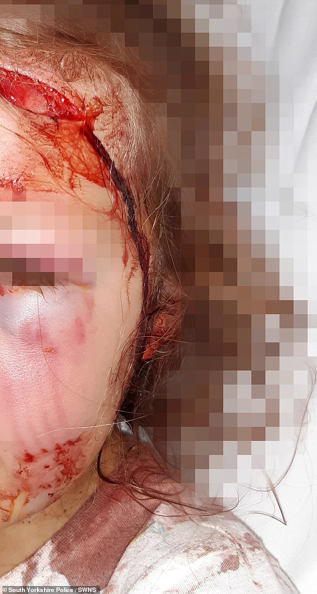 Gruesome photos of the little girl after the attack show the side of her face and ears covered in blood