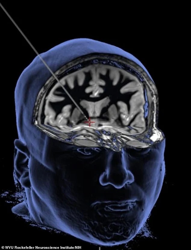 Zapping the brain with ultrasound might be key to curing