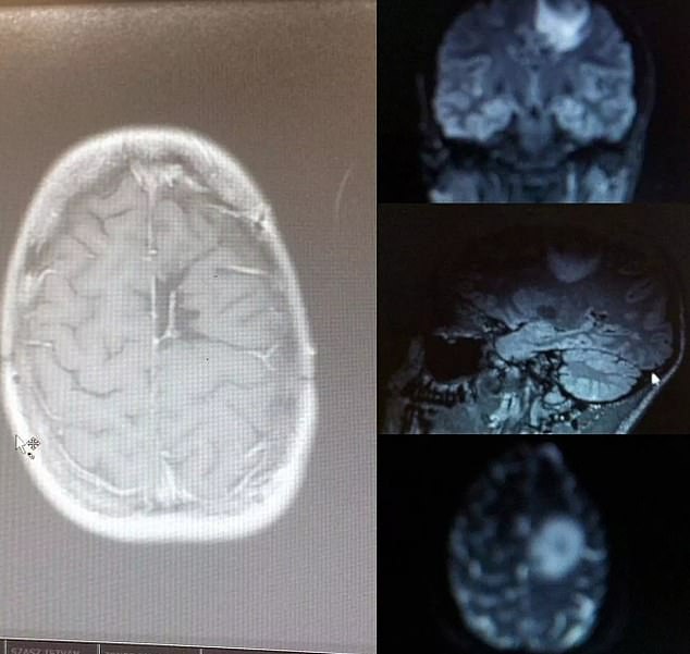 It was only after the now 33-year-old blacked out twice again at the gym that she sought further medical attention. An MRI scan showed she had a tumor the size of a golf ball in her brain