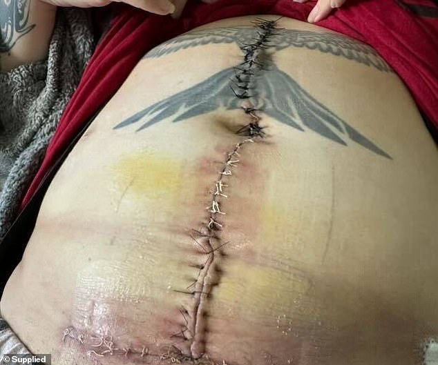 Haylee Loccisano is permanently disfigured with an 18-inch scar on her stomach