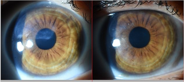 The photo (left) shows the scar blocking the pupil and vision, and the photo on the right shows how specialist treatment removed the scar area in the pupil while significantly reducing myopia (nearsightedness)