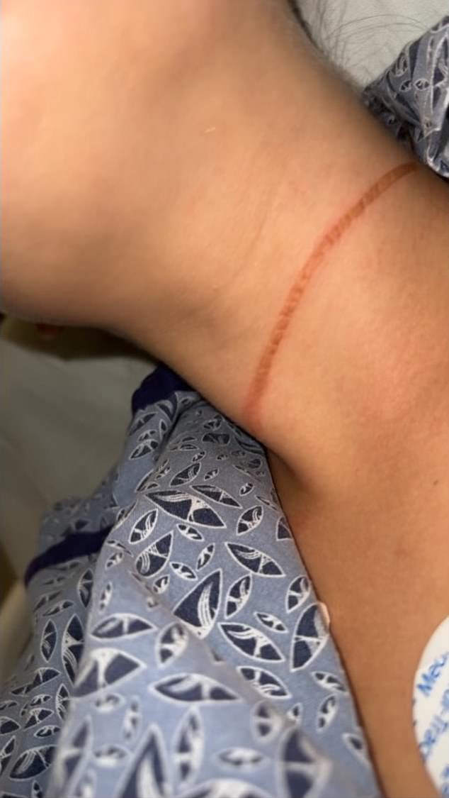 The strangulation marks around Wood's neck, taken while she was in hospital after the near-fatal attack that took place at the Plaza hotel last month