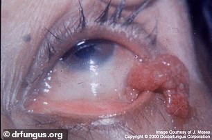 The above shows a patient with a rhinosporidiosis infection, the same infection that the Indian case study patient had