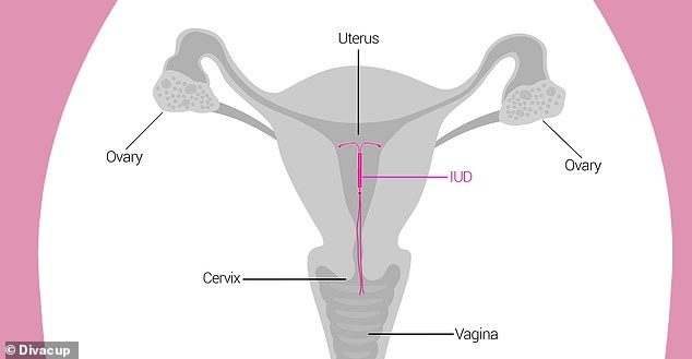 An IUD is inserted through a tube into the vagina and passes through the cervical opening into the uterus