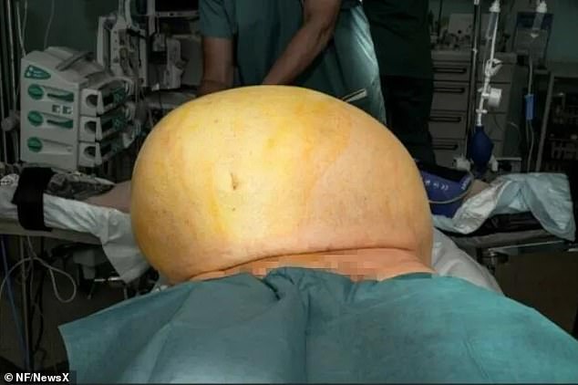 The enormous tumor, shown here just before removal, weighed 60 pounds and measured 20 inches in diameter